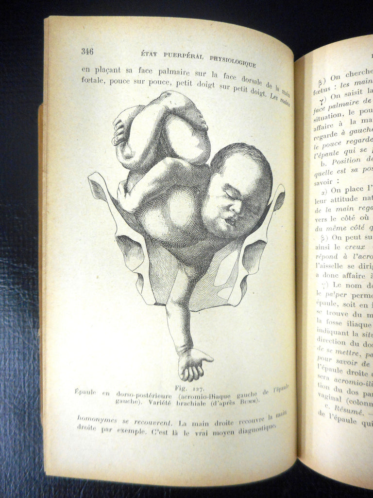 Antique 1922 Medical Obstetric Book by Maygrier and Schwaab, 336 Child Birth Illustrations, Delivery Methods